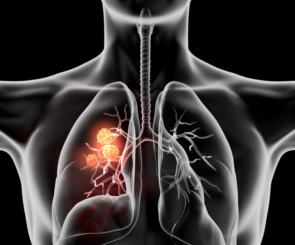 Lung Carcinoma, Medically Illustration 3DOn Black Background