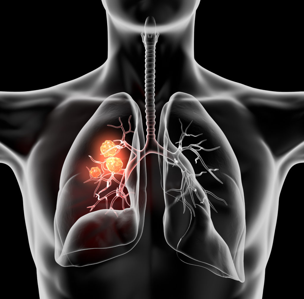 Lung cancer on black background, 3D illustration