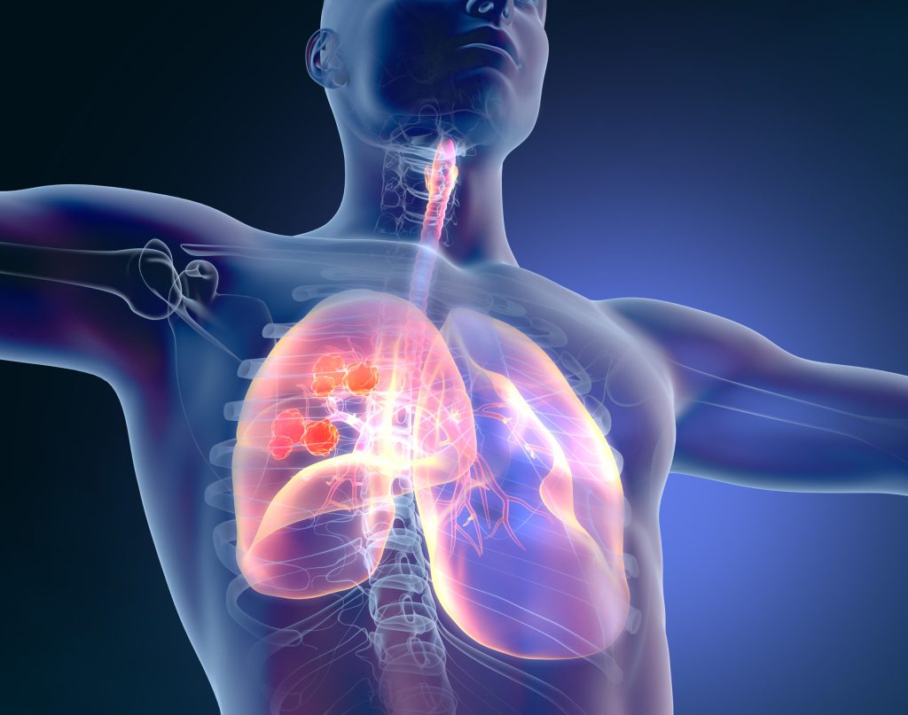 Lung Cancer, Medical Illustration