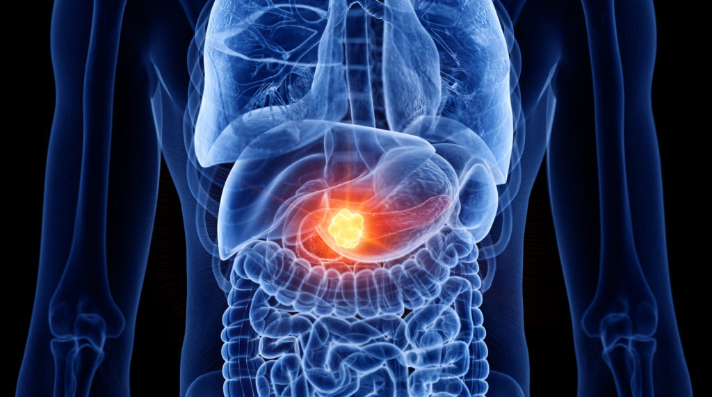 3D Rendered Medically Accurate Illustration Of Pancreas Cancer
