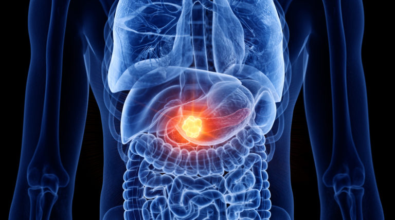 3D Rendered Medically Accurate Illustration Of Pancreas Cancer