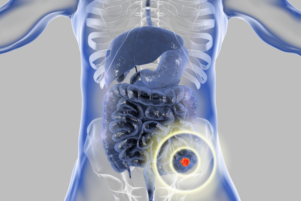 Colorectal cancer awareness medical concept. Concept of cancer treatment and prevention, 3D illustration