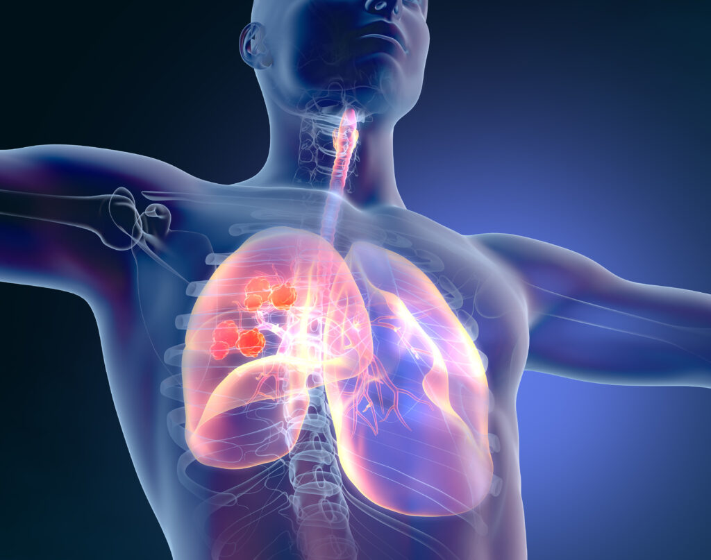 Lung cancer on blue background, 3D illustration