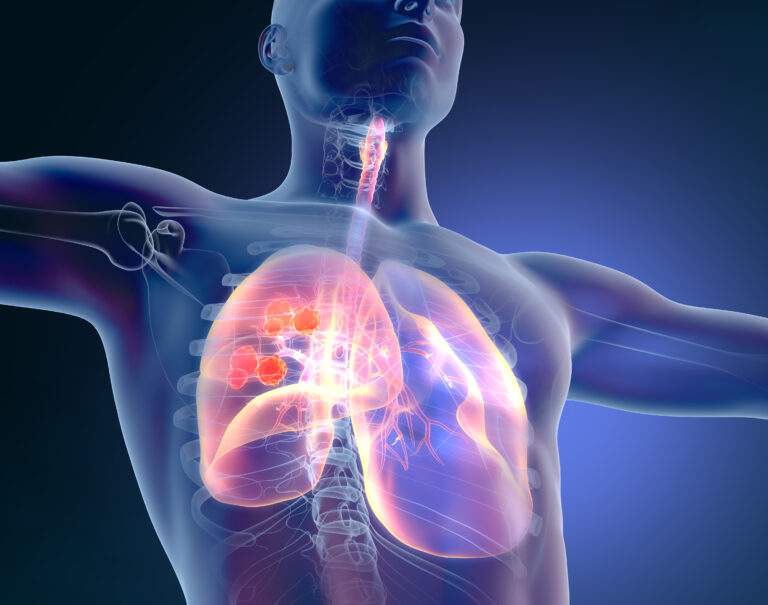 Lung cancer on blue background, 3D illustration