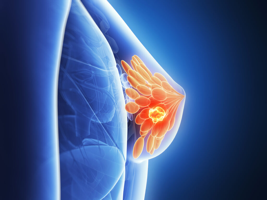 3d rendered illustration breast cancer