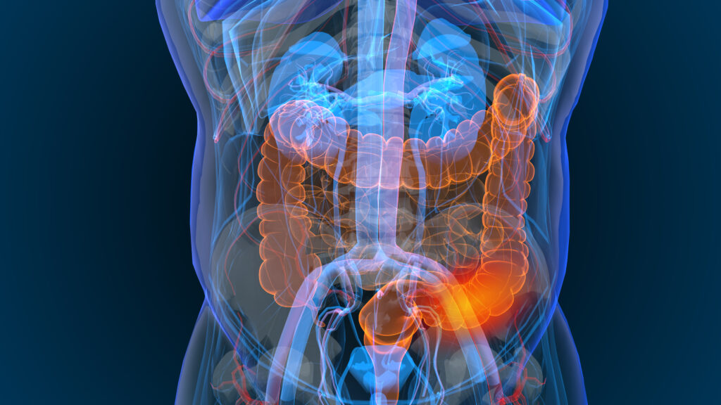 3d rendered illustration of bowel cancer 3D illustration