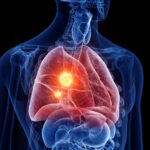 Improved Survival with a Chemotherapy Free Option for EGFR Mutated Lung Cancer