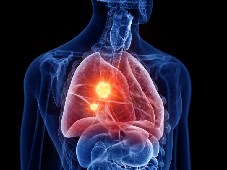 3d rendered medically accurate illustration of lung cancer